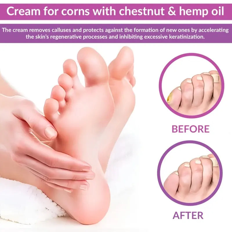 Callus Cream for Dry & Hardened Feet With Horse Chestnut & Hemp Oil Intensive Foot Care