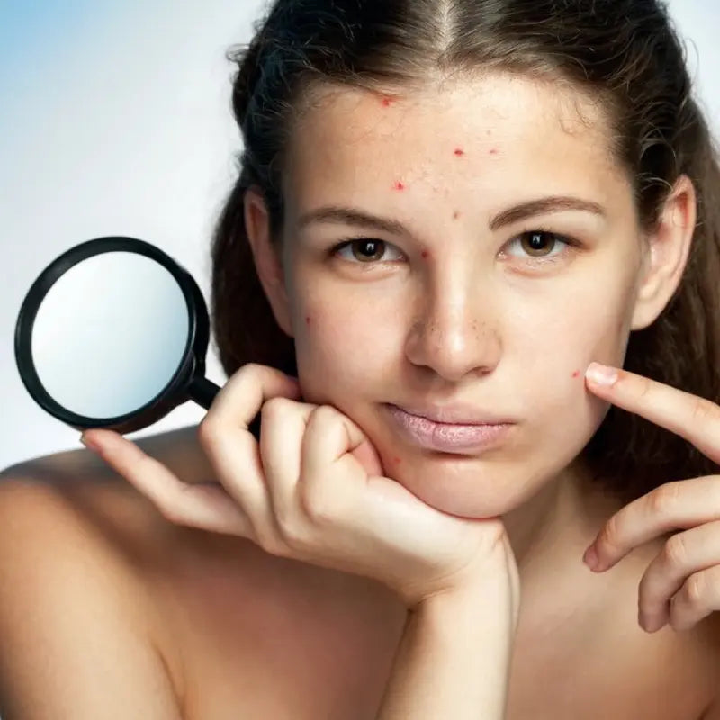 Ichthyol Ointment Intensive Anti-Acne Spot Cream Problematic Skin Maść Ichtiolowa