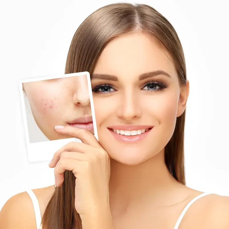 Zinc Ointment Lassari Anti-Acne Pimple Treatment Spot Cream